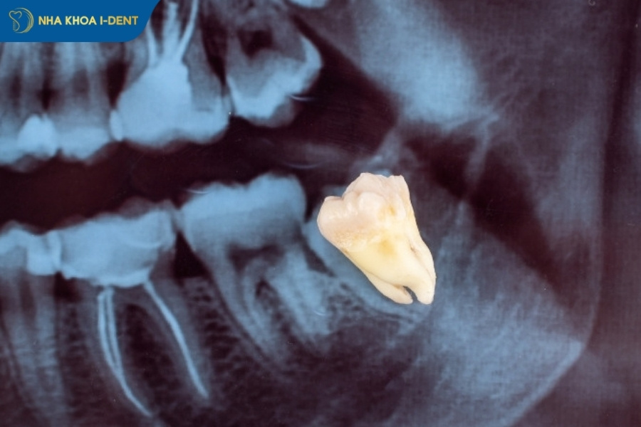 nhổ răng khôn mọc lệch