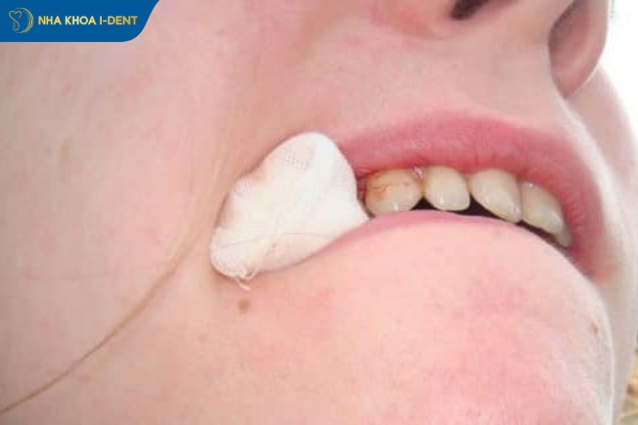 nhổ răng khôn xong có lỗ