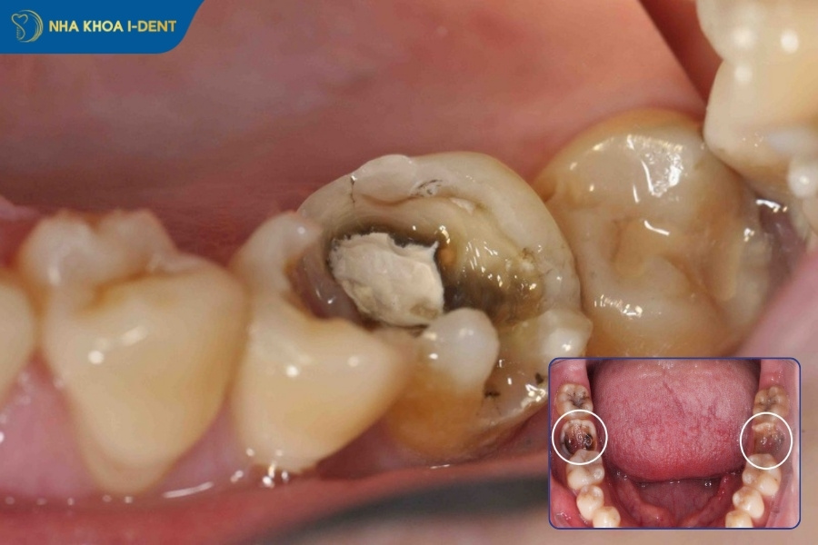 nhổ răng số 7 hàm trên