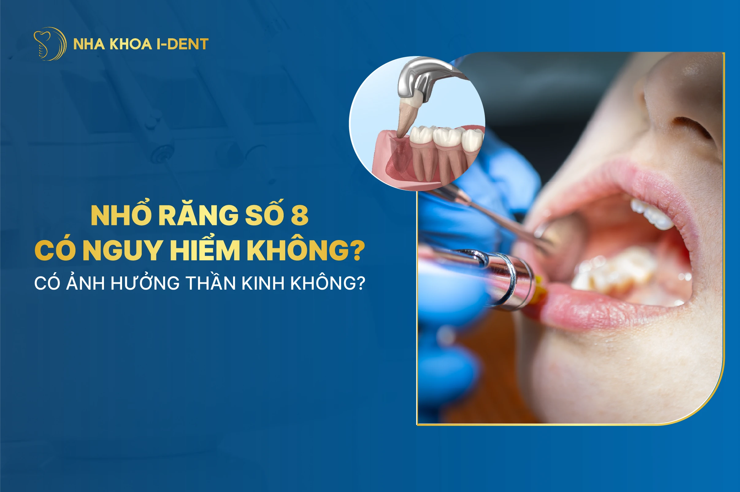 Nhổ răng khôn có nguy hiểm không? Có ảnh hưởng thần kinh không?