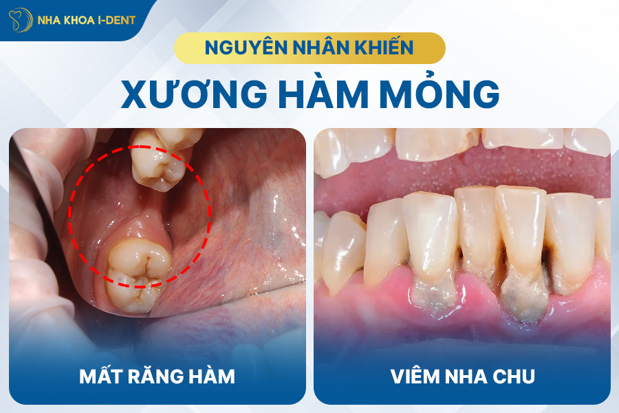 niềng răng bị tiêu xương