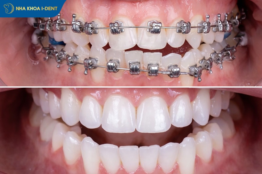 Tình trạng răng mọc khấp khểnh, lộn xộn cần nhổ răng khi niềng