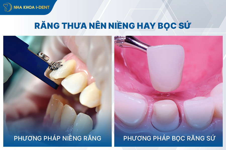 niềng răng cửa thưa