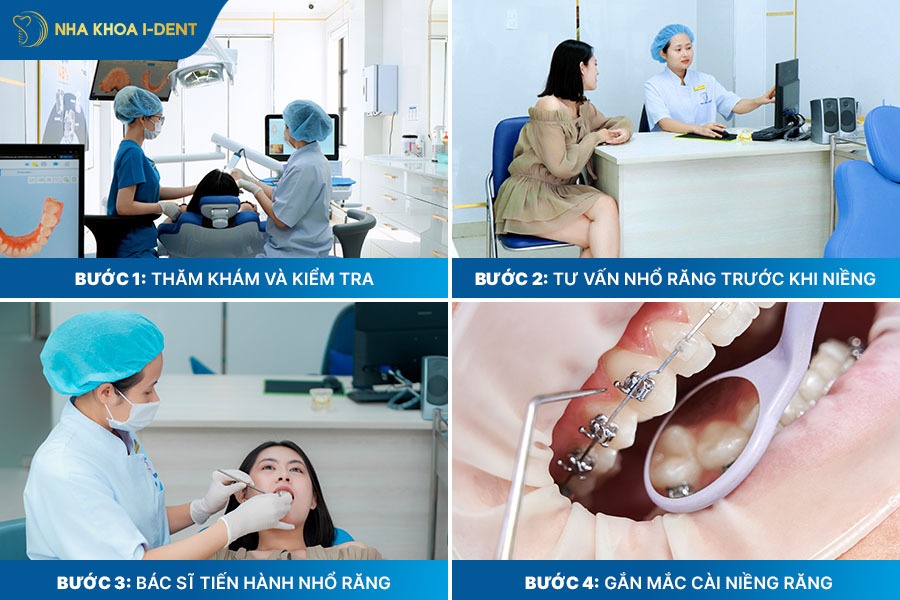 nhổ răng khi niềng