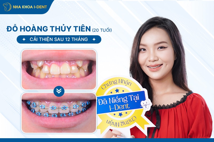 phương pháp niềng răng hiện nay