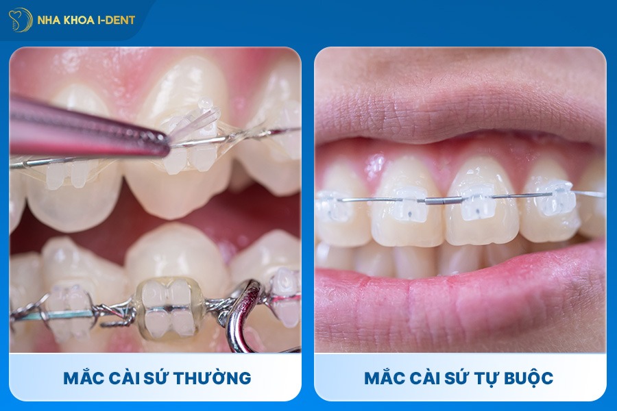 Phương pháp niềng răng mắc cài sứ