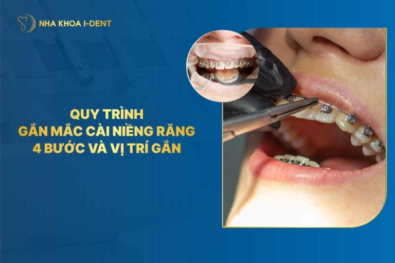 Quy trình gắn mắc cài niềng răng 4 bước và vị trí gắn