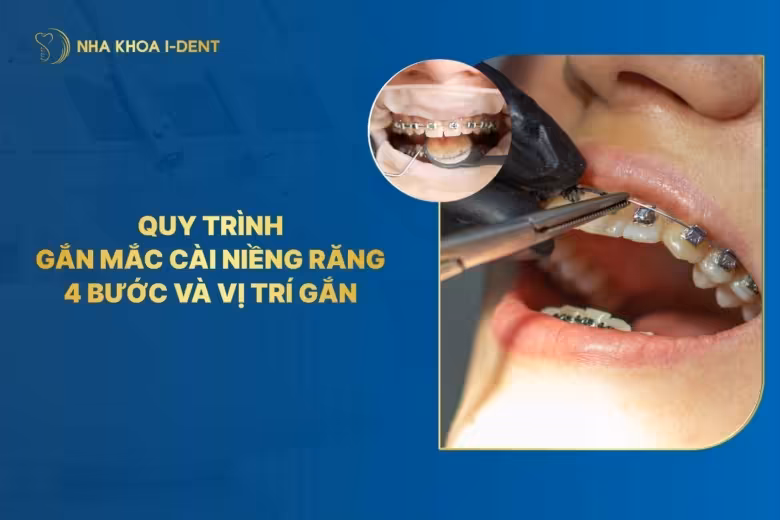 Quy trình gắn mắc cài niềng răng 4 bước và vị trí gắn