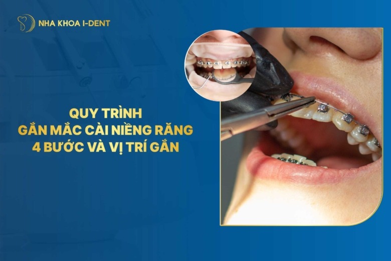 Quy trình gắn mắc cài niềng răng? Vị trí gắn?