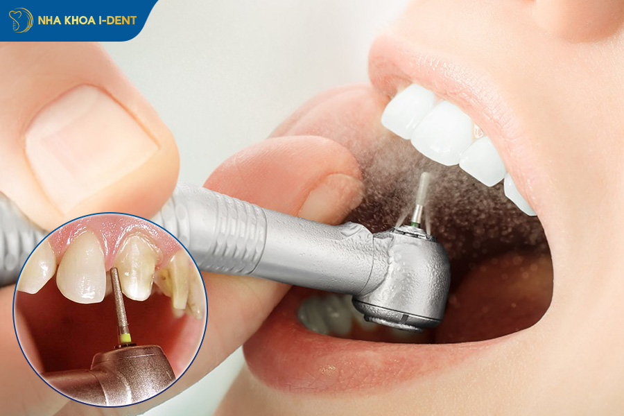 răng bị lệch khớp cắn