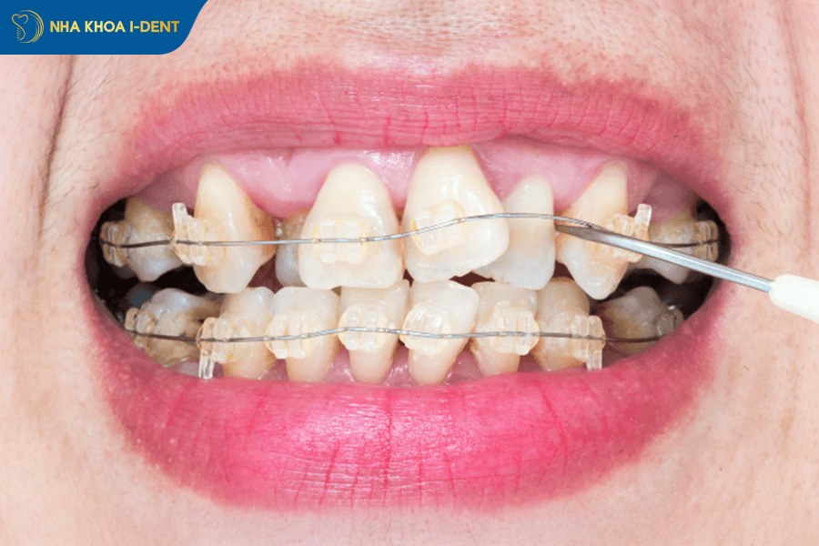 răng đều như hạt bắp