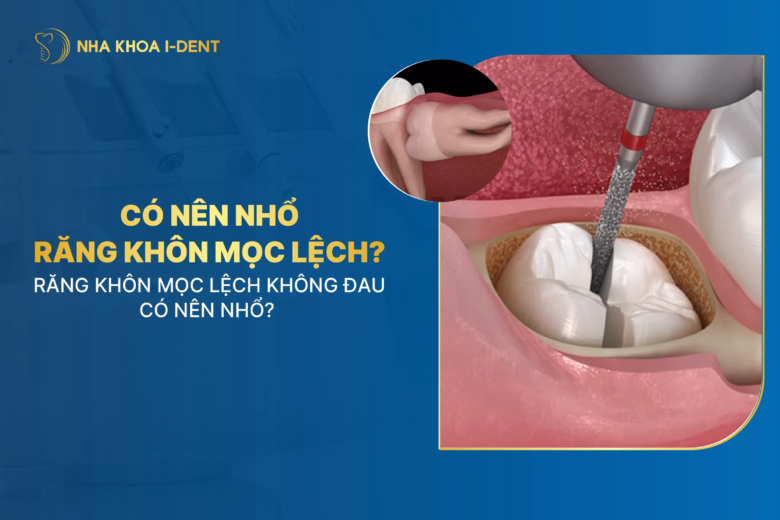 răng khôn mọc lệch nhưng không đau có nên nhổ