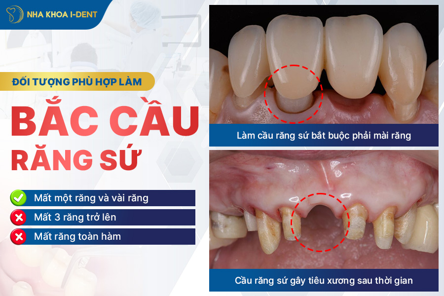Răng sứ implant