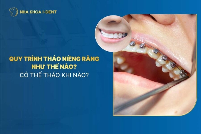 tháo niềng răng