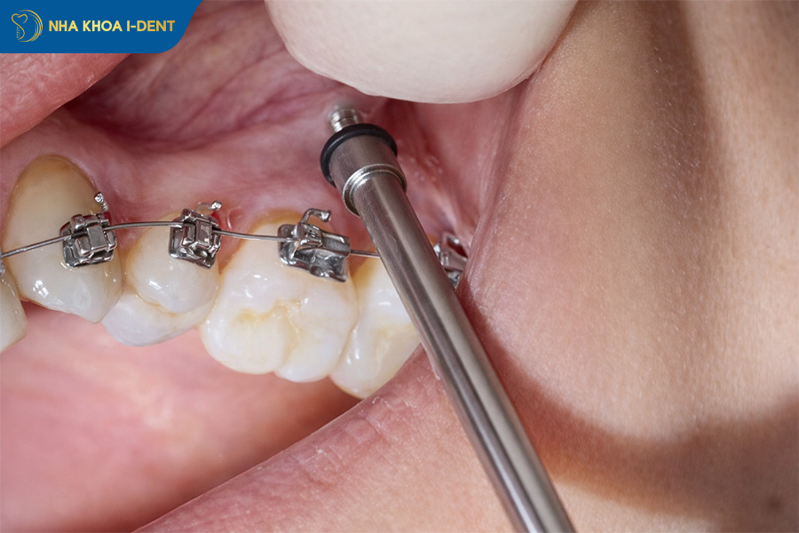 tháo vít niềng răng