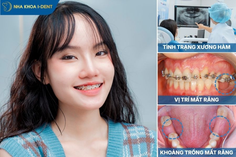 thiếu răng có niềng được không