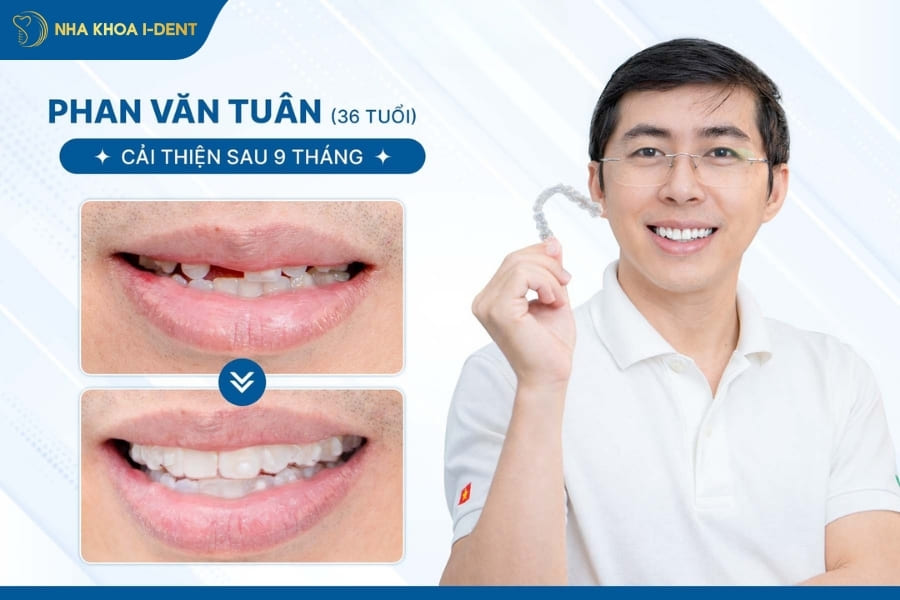 bị mất răng có niềng được không
