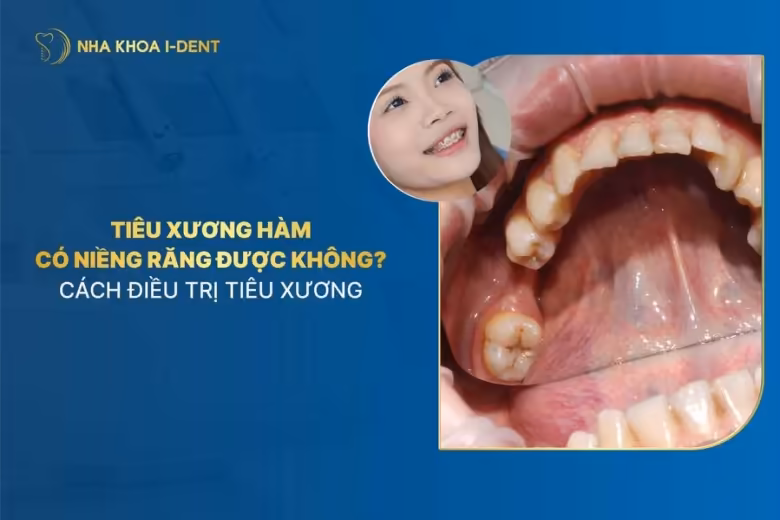 tiêu xương hàm có niềng răng được không