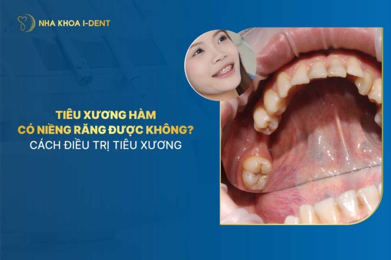 Tiêu xương hàm có niềng răng được không? Cách điều trị tiêu xương hàm