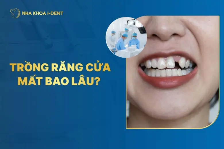 Trồng răng cửa mất bao lâu? Phương pháp nào?