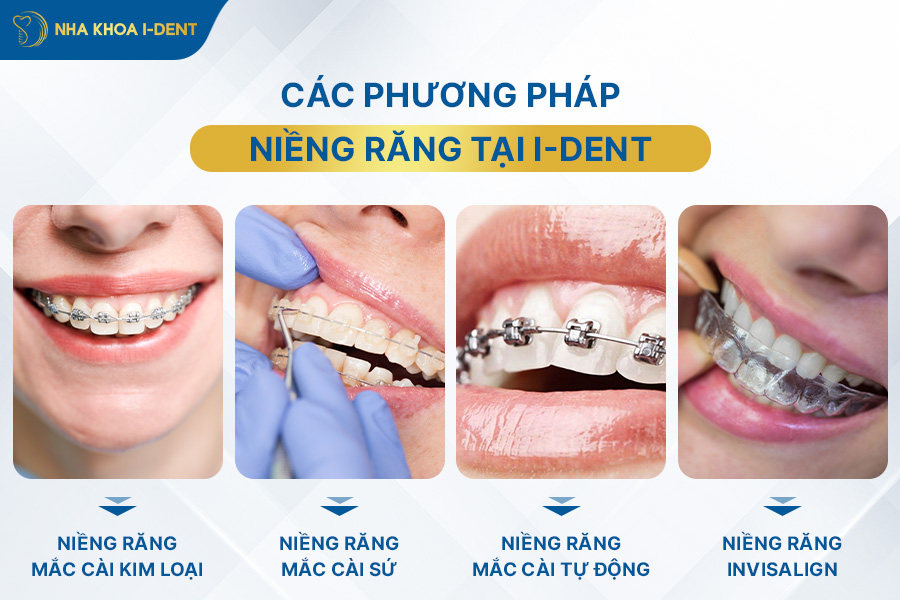 tư vấn niềng răng hô