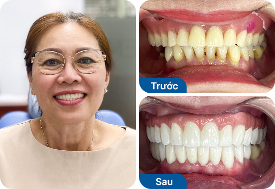 Cô Mai trồng răng Implant All-on-6 hàm trên tại nha khoa I-Dent.