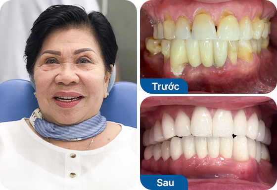 Cô Trâm trồng răng Implant All-on-4 hàm dưới tại nha khoa I-Dent.