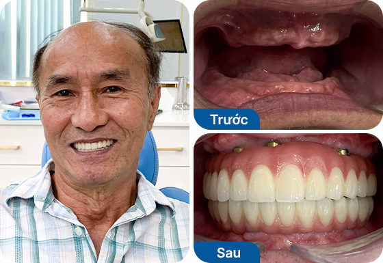 Chú Hưởng trồng răng All-on-5 hàm trên, All-on-6 hàm dưới tại nha khoa I-Dent.