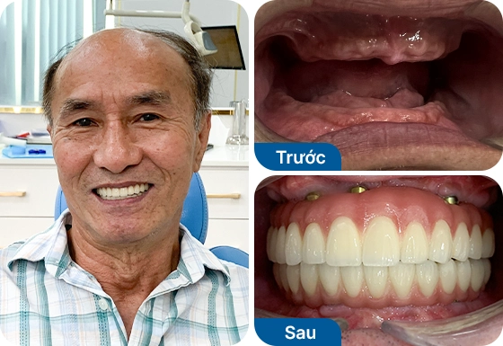 Chú Hưởng trồng răng All-on-5 hàm trên, All-on-6 hàm dưới tại nha khoa I-Dent.