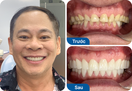 Chú Mừng trồng răng Implant đơn lẻ tại nha khoa I-Dent.