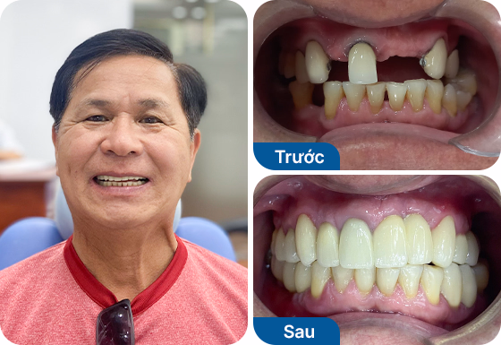 Chú Chí Trần trồng răng Implant đơn lẻ tại nha khoa I-Dent.