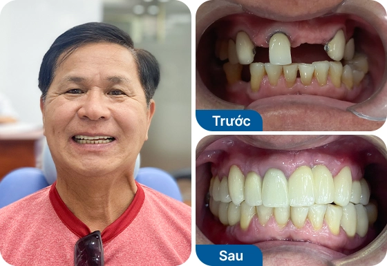 Chú Chí Trần trồng răng Implant đơn lẻ tại nha khoa I-Dent.