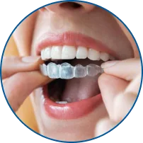 Invisalign Lite