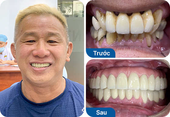 Chú Huy Lý trồng răng Implant All-on-4 hàm trên tại nha khoa I-Dent.