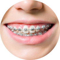 Self Ligating Metal Braces