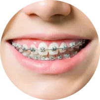 Kim Loại Tự Buộc