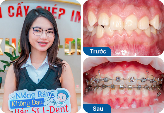 Chị Thanh Nhàn niềng răng mắc cài kim loại tại nha khoa I-Dent.