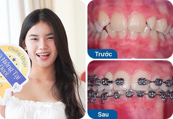 Chị Tường Lan niềng răng mắc cài kim loại tại nha khoa I-Dent.