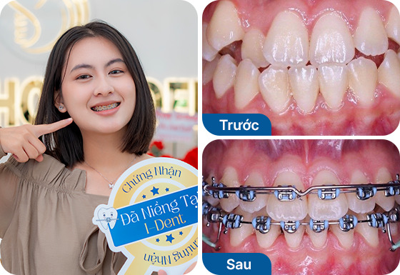 Chị Thùy Trang niềng răng mắc cài kim loại tại nha khoa I-Dent.
