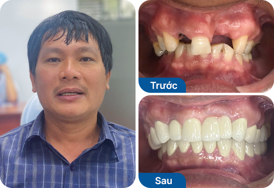 Chú Hào trồng răng Implant đơn lẻ tại nha khoa I-Dent.