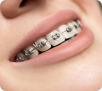 Mắc cài kim loại tiêu chuẩn