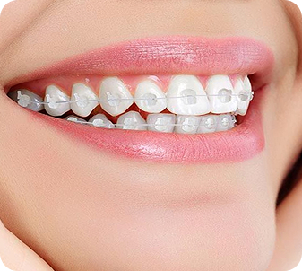 Mắc cài sứ tiêu chuẩn
