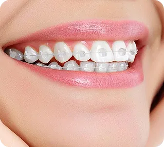 Mắc cài sứ tiêu chuẩn