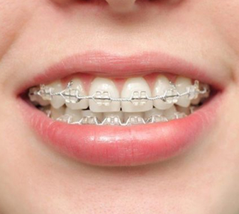 Mắc cài tự buộc