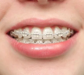 Mắc cài tự buộc