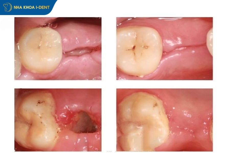 vết khâu nhổ răng khôn bị hở