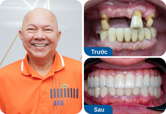Chú Nguyễn Văn Huy trồng răng Implant All on 5 hàm trên tại nha khoa I-Dent.