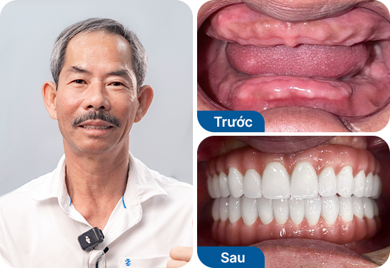 Chú Ngô Văn Út trồng răng implant toàn hàm All-on-6 tại nha khoa I-Dent.