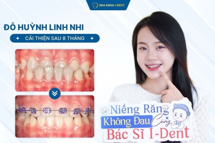 16 tuổi niềng răng bao lâu - Nha khoa I-Dent