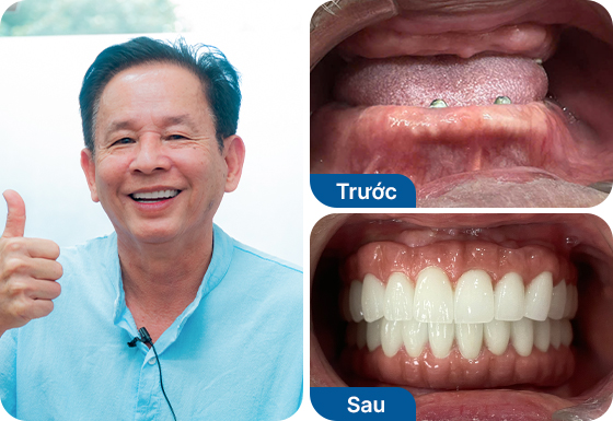 Chú Nguyễn Minh Hào trồng răng implant All on 6 hàm dưới, All on 5 hàm trên tại nha khoa I-Dent.